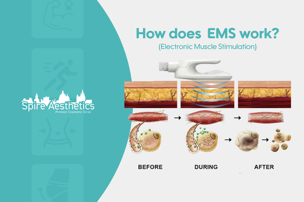 EMS treatment for post pregnancy weight loss treatment Burgess Hill