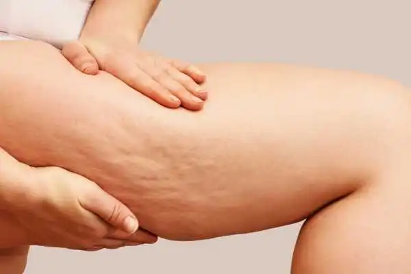 Image of woman showing leg with cellulite Burgess Hill