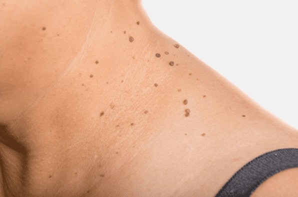 Are you looking for easy skin tag removal Burgess Hill - then contact Spire today!