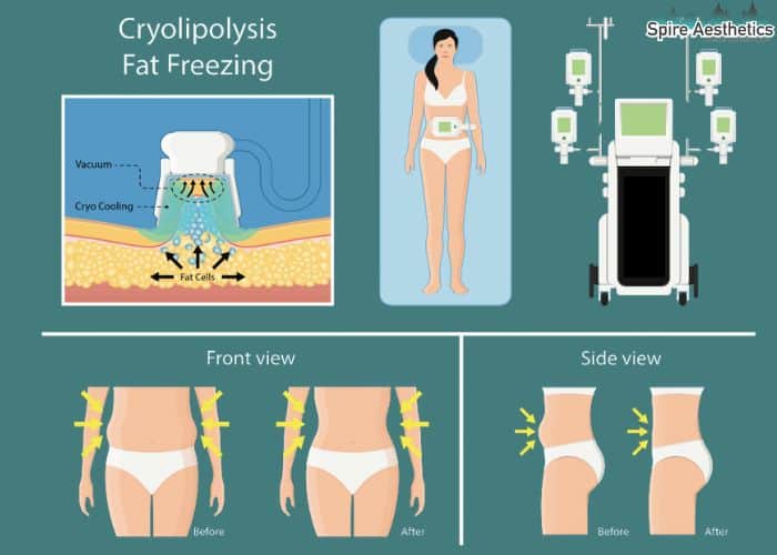 Image of diet and fat freezing combined for best results for Spire Aesthetics Burgess Hill