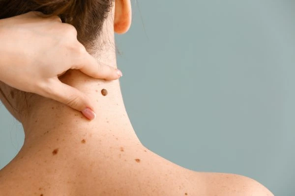 skin blemish removal Burgess Hill treatment